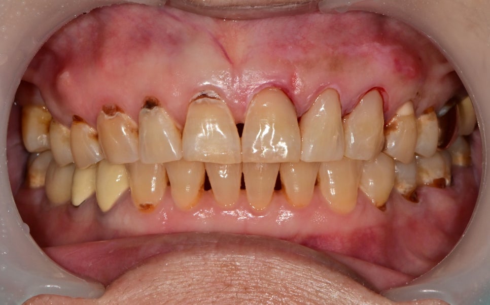 옥수동 치과 앞니 충치가 생기는 원인, 치료방법 (심미치료, 레진) 관련 이미지 3