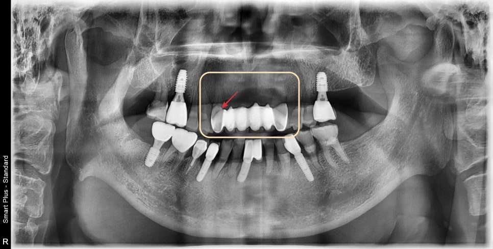 한남동 주변 치과 구강 스캐너를 이용한 가이드 임플란트 수술(무절개 수술) 관련 이미지 1