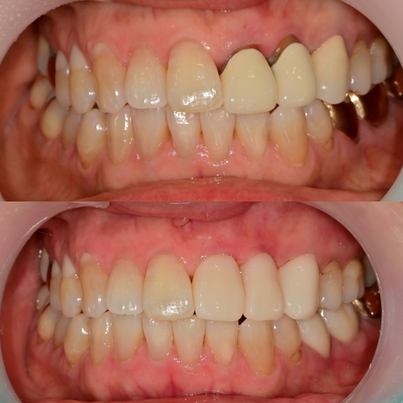 약수역 치과 오래된 앞니 크라운 재보철치료시 주의할 사항 관련 이미지 8