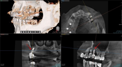 신당동 치과 씹을 때마다 아플 때 임플란트 치아의 문제 관련 이미지 9