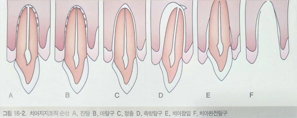 약수역 치과, 넘어지거나 외상에 의한 치아 파절 시 흔들리는 치아 치료하는 방법 ( 심미보철, 신경치료, 치아 고정술) 관련 이미지 1