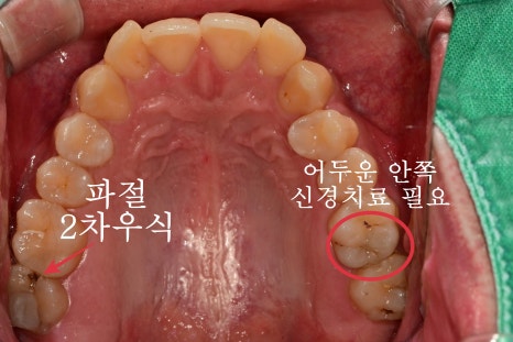 서울중구치과치료 신경치료받은 치아 크라운이 필요한가요? 관련 이미지 2