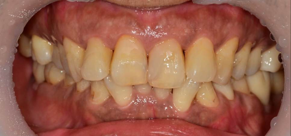 약수역 치과, 미뤄둔 임플란트 치료하기 (치과가 무서워요) 관련 이미지 7