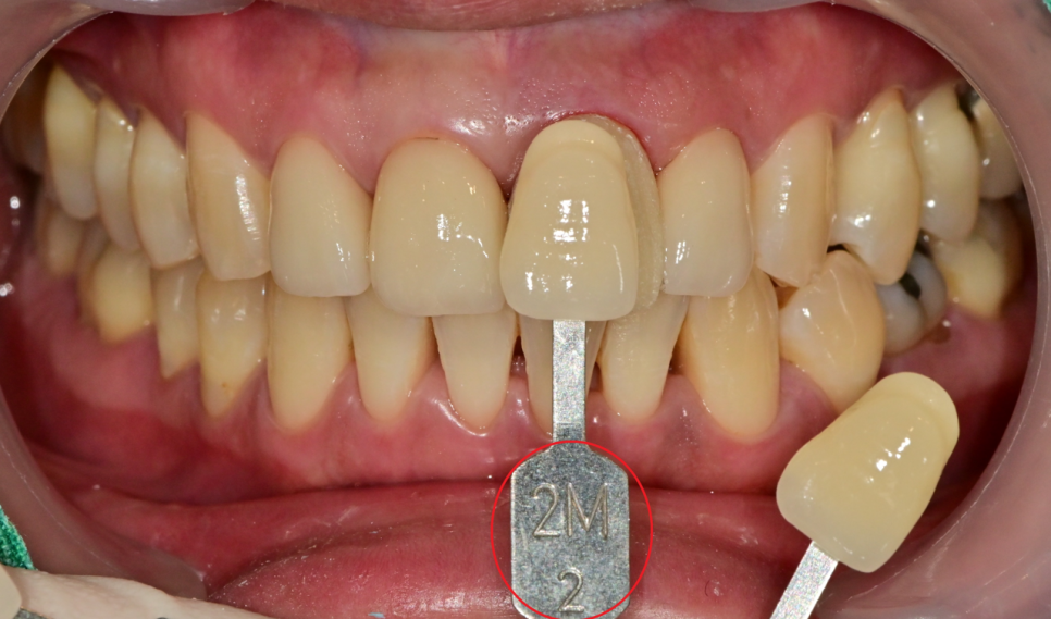 약수역 치과, 전치부 심미 보철 재치료(보철물 파절의 원인) 관련 이미지 6