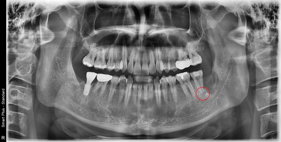 약수역 치과, 어려운 신경형태의 치아 신경치료 할때 주의할점 ( C형 근관, 신경관 찾기, 치아보존치료) 관련 이미지 2