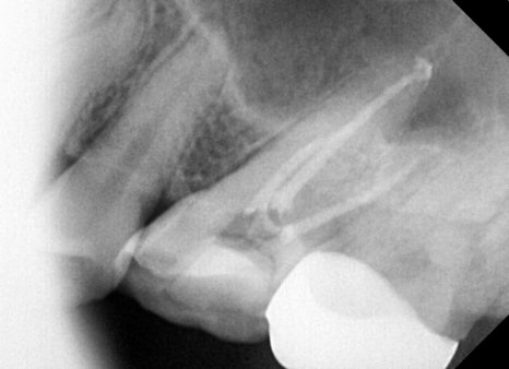 금남시장 치과, 잇몸염증이 생긴다면 원인과 치료 방법은?? ( 양치할 때 피나요, 치아색이 이상해요) 관련 이미지 7