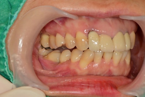 신금호역 주변 치과 치아가 빠진 후 시간이 오래 지나면 생기는 문제점 관련 이미지 3