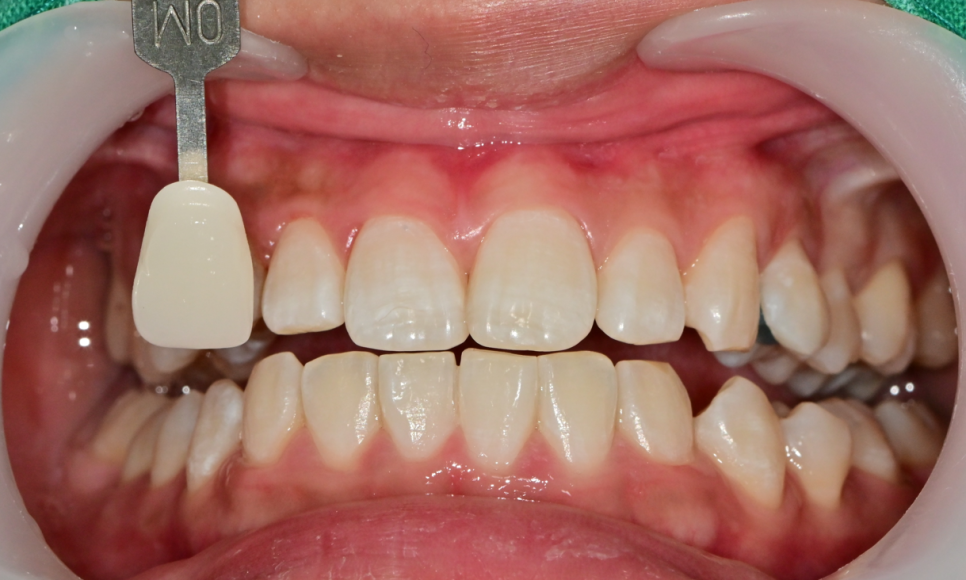 약수역 치과, 치아 미백 1회 방문으로 효과가 있을까?(feat. 원데이 미백) 관련 이미지 6