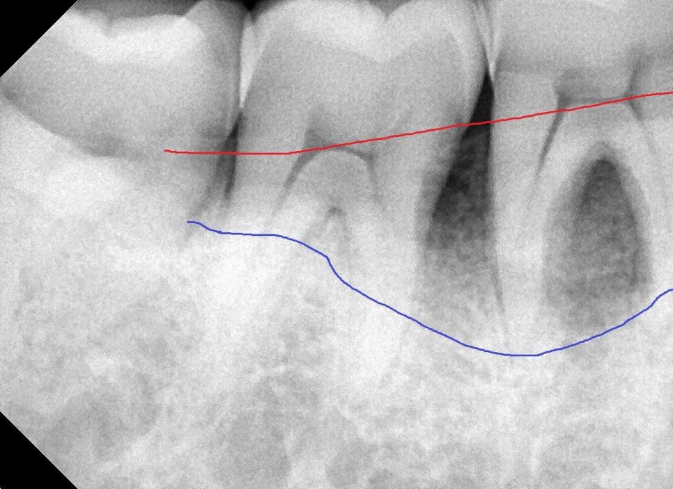 약수동 치과, 치주 질환이 진행된 잇몸에서 항상 붓고 피가 나는 이유(잇솔질, 워터픽, 잇몸치료) 관련 이미지 4