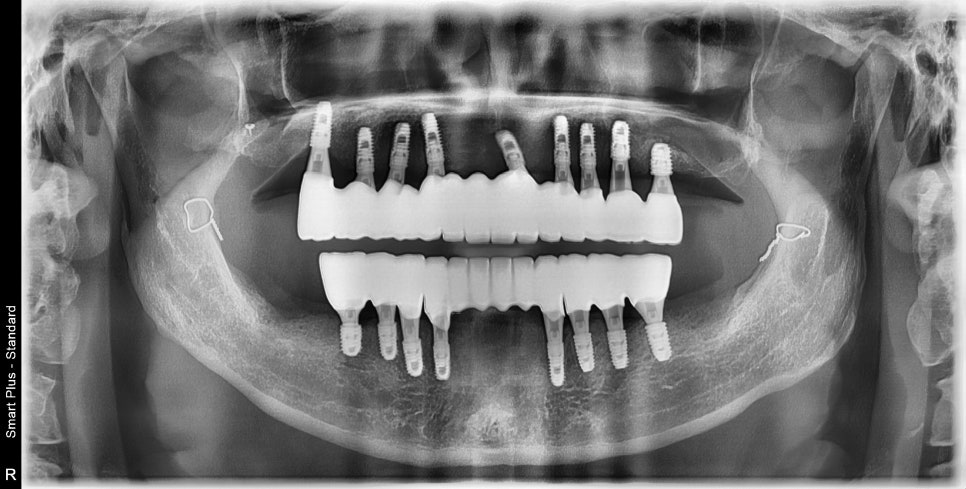 Dental Clinic Near Yaksu Station: How Many Implants Are Needed for Full-Mouth Implants? image 2