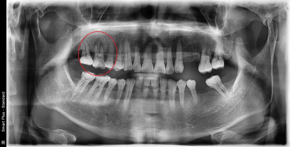 약수역치과, 뿌리염증 치아 신경치료하기( 금 간 치아) 관련 이미지 1