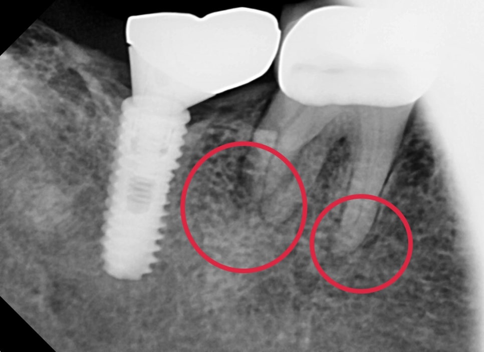 옥수동 크라운치료된 통증 있는 치아의 (재)신경치료 과정 관련 이미지 3