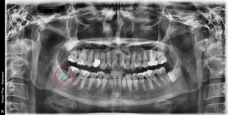약수역 치과, 금 간 치아( 크랙 치아)로 인한 뿌리 주변 염증이 생겼을 때 치료방법( 임플란트, 치조골 이식술) 관련 이미지 1
