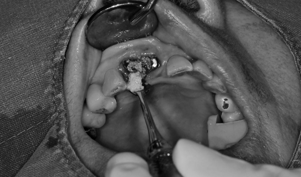 약수동 치과 내려앉은 잇몸 공간 치아삭제 없이 치료하기 관련 이미지 5