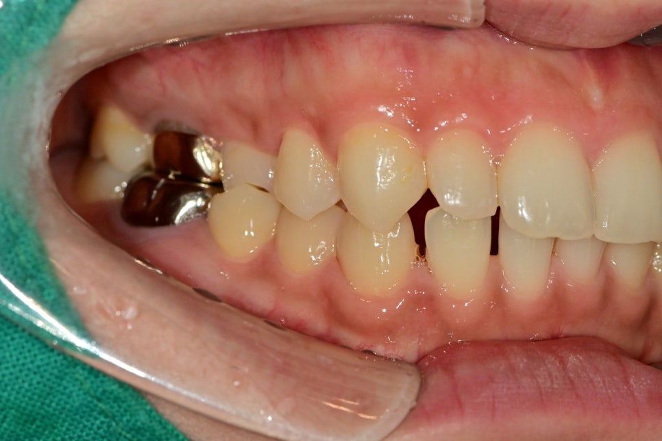 약수역치과 벌어진 앞니(치간이개) 레진을 이용한 치료방법 관련 이미지 2