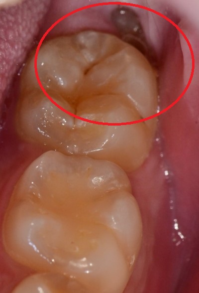 금호동 치과, 사랑니 때문에 주변 잇몸이 붓는 이유 (매복 사랑니 주변 치은염) 관련 이미지 2