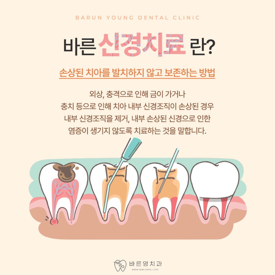 금호역치과, 통합치의학과 전문의가 1:1로 하는 충치신경치료 관련 이미지 6