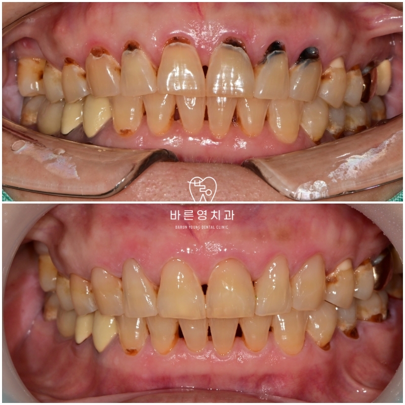 옥수동 치과 앞니 충치가 생기는 원인, 치료방법 (심미치료, 레진) 관련 이미지 4