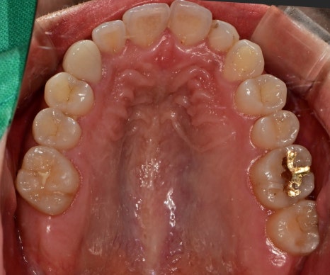 동대입구역 치과 이갈이 장치 제작이 필요한 경우(턱관절 통증) 관련 이미지 1