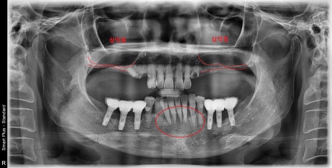 신당 임플란트, 심을까 말까 고민되신다면?? (고난도 골이식 임플란트 기간 및 통증) 관련 이미지 5