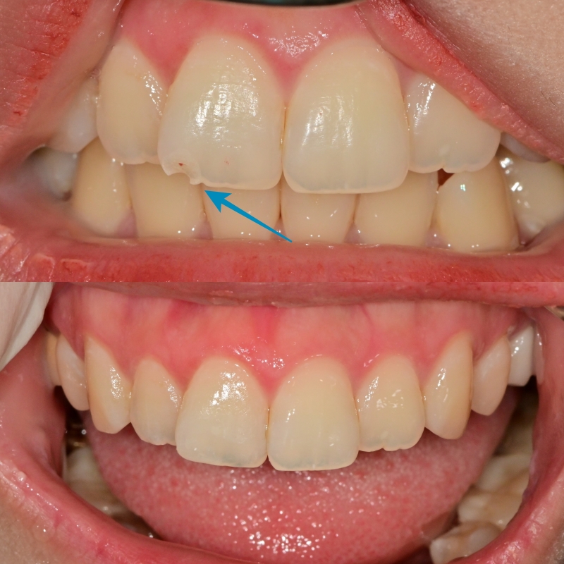 동대입구 주변 치과 앞니 깨졌을 때 치아삭제 없이 치료 관련 이미지 3