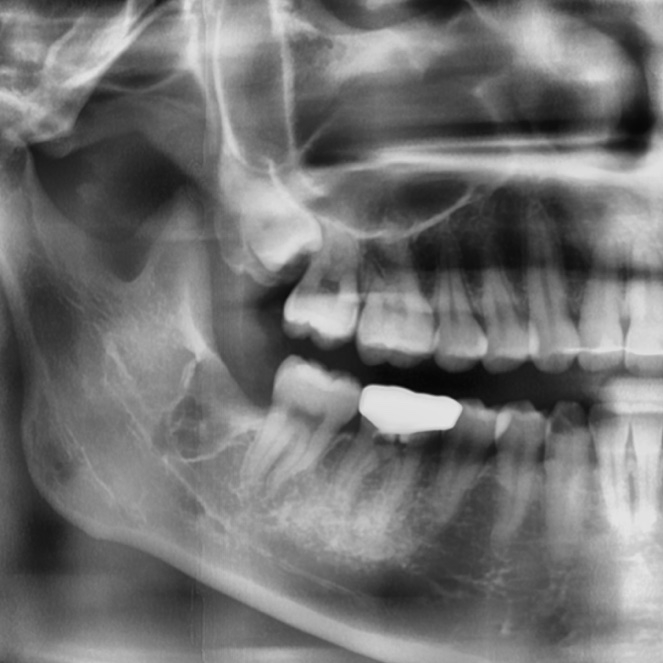 약수치과, 통증 있다면 사랑니발치 미루지 마세요 관련 이미지 8