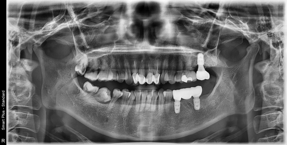 신금호역 주변 치과 치아가 빠진 후 시간이 오래 지나면 생기는 문제점 관련 이미지 5