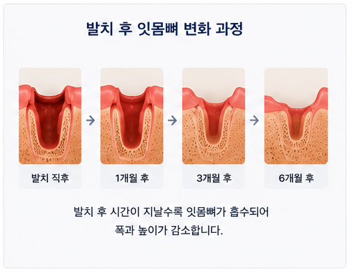 약수역 치과 발치후 임플란트 식립시기는 어떻게 정해질까요? 관련 이미지 2