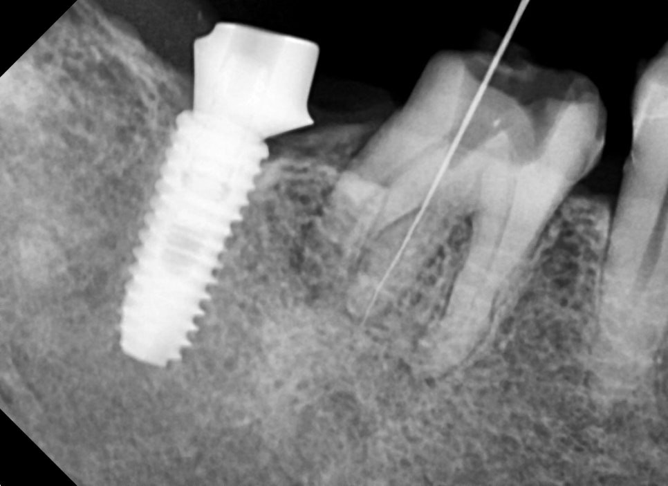 옥수동 크라운치료된 통증 있는 치아의 (재)신경치료 과정 관련 이미지 4