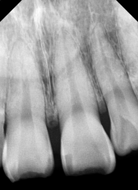 버티고개역 치과 앞니 외상에 따른 치료방법( 넘어져서 치아가 부러졌어요) 관련 이미지 4