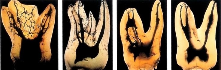 약수역 치과 오래된 신경치료 다시 하기 관련 이미지 1