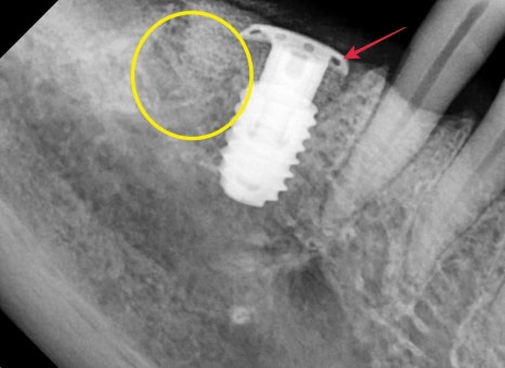 청구역 치과 치주염으로 다수의 치아가 흔들리는 경우(발치, 임플란트) 관련 이미지 9