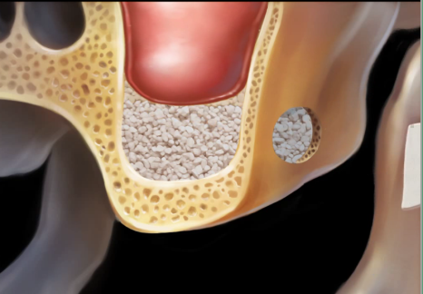 약수역 치과 비염 수술 후 상악동 임플란트 과정 관련 이미지 5