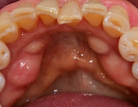 약수역 치과, 양치질 할때 피나고 냄새나는 잇몸병 관리 방법(워터픽, 먹는약) 관련 이미지 5