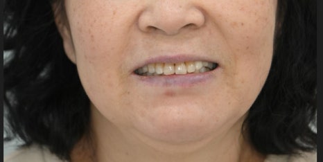 약수동 치과, 광범위한 뼈이식 임플란트 수술 후 회복 과정 관련 이미지 10