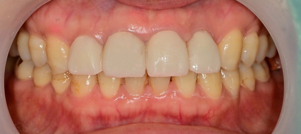 금호역치과 비율이 안 맞는 앞니 재보철치료 관련 이미지 3