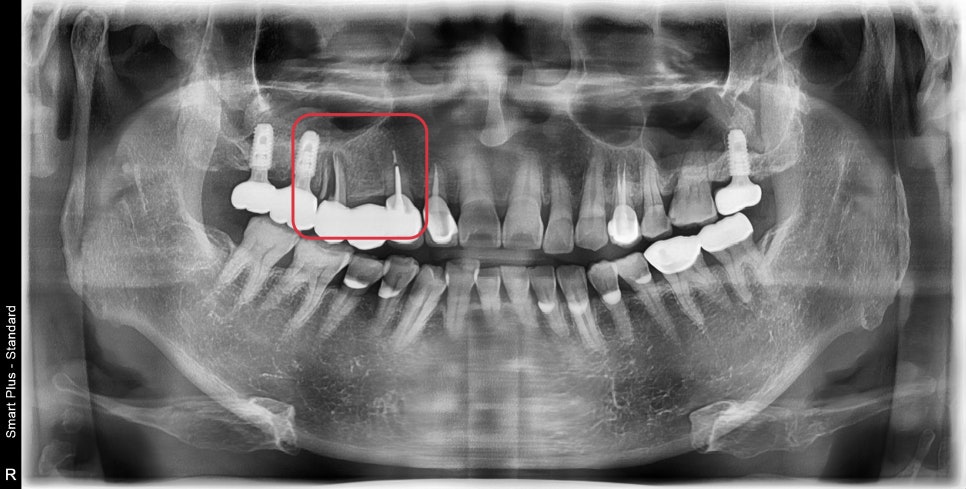금호동 치과 신경치료된 치아 주변 염증 방치하면 안 되는 이유(발치후 임플란트) 관련 이미지 6