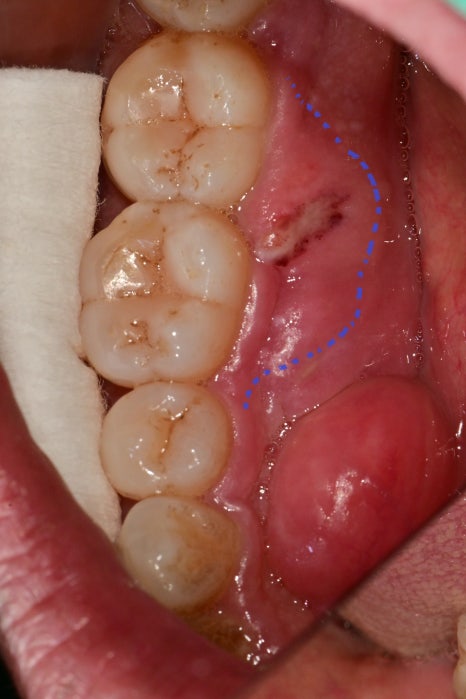 약수동 치과, 치주 질환이 진행된 잇몸에서 항상 붓고 피가 나는 이유(잇솔질, 워터픽, 잇몸치료) 관련 이미지 3