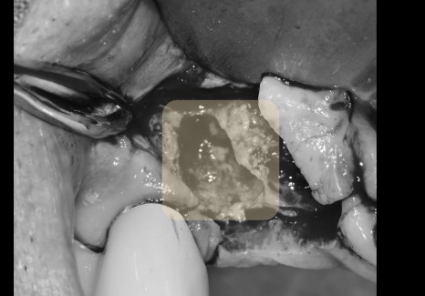 신당역 임플란트 풍치, 심한 치주염인 경우 치과에서 치료 순서 관련 이미지 7