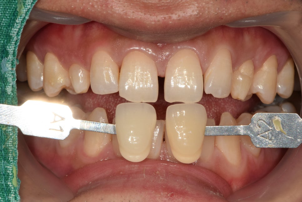 청구동 치과 앞니 라미네이트를 하는 이유 관련 이미지 3