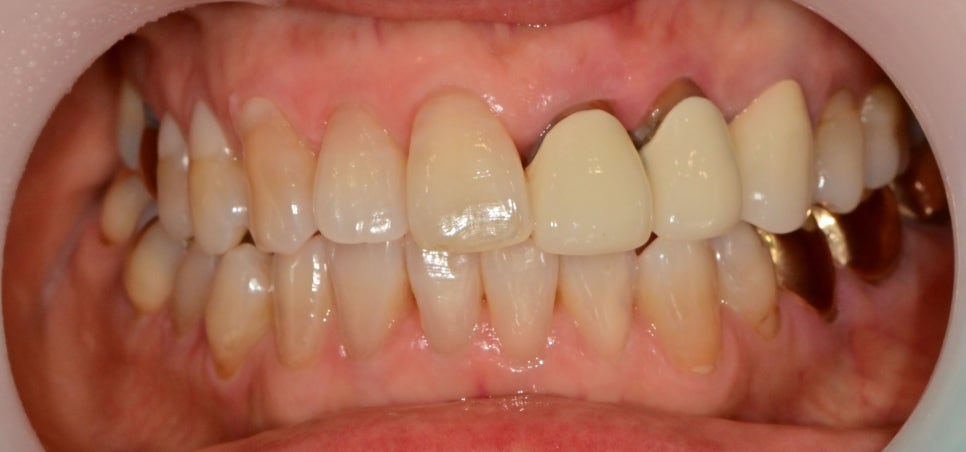 약수역 치과 오래된 앞니 크라운 재보철치료시 주의할 사항 관련 이미지 1