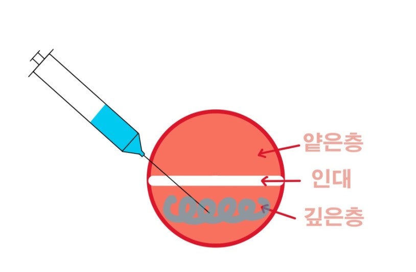 신당동 치과, 턱 보톡스 주사 이후에 나타날 수 있는 증상 ( 사각턱, 저작근, 볼 알사탕 현상) 관련 이미지 5