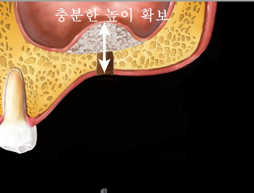 신당동 치과 오래전 빠진 치아 상태에서 임플란트 수술(상악동 거상술) 관련 이미지 4