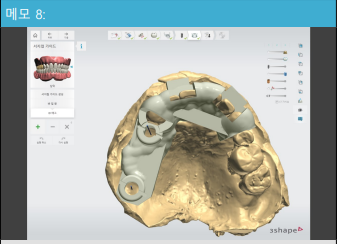 한남동 치과 디지털을 이용한 오차는 줄이고 편안함은 높이는 임플란트 관련 이미지 5