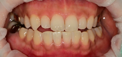약수역치과 벌어진 앞니(치간이개) 레진을 이용한 치료방법 관련 이미지 5