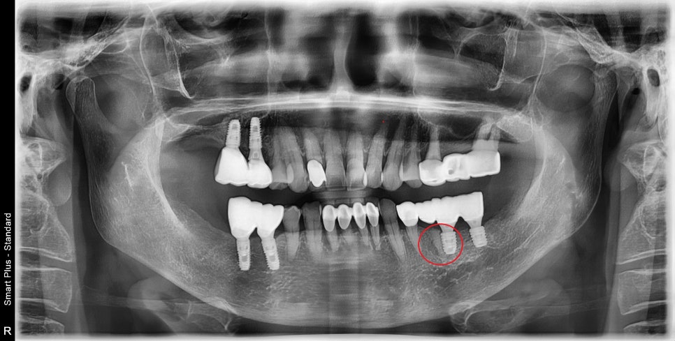 약수역 치과, 임플란트는 치아 개수마다 꼭 필요한가요?( 임플란트 진단이 모두 다른 이유??) 관련 이미지 3