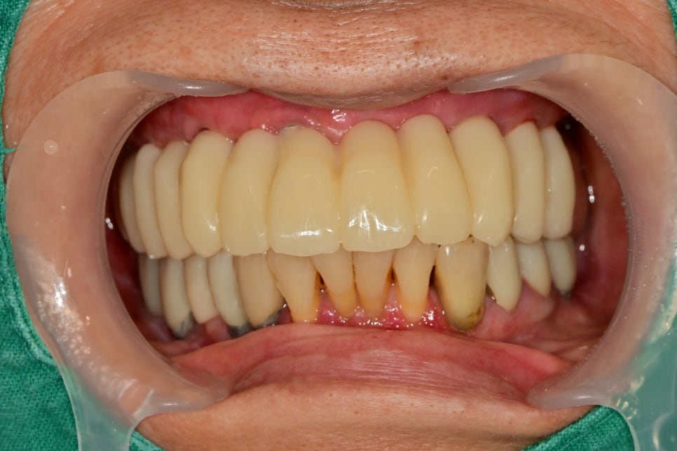 약수동 치과, 전체틀니 오래 쓰신분들 전체 임플란트 가능한가요??(치조골의 흡수양상과 모양) 관련 이미지 5