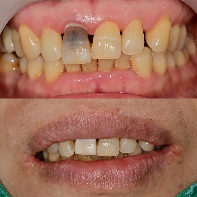 금호동 치과 앞니 임플란트 수술 후 빈 공간 임시로 회복하는 방법 관련 이미지 3