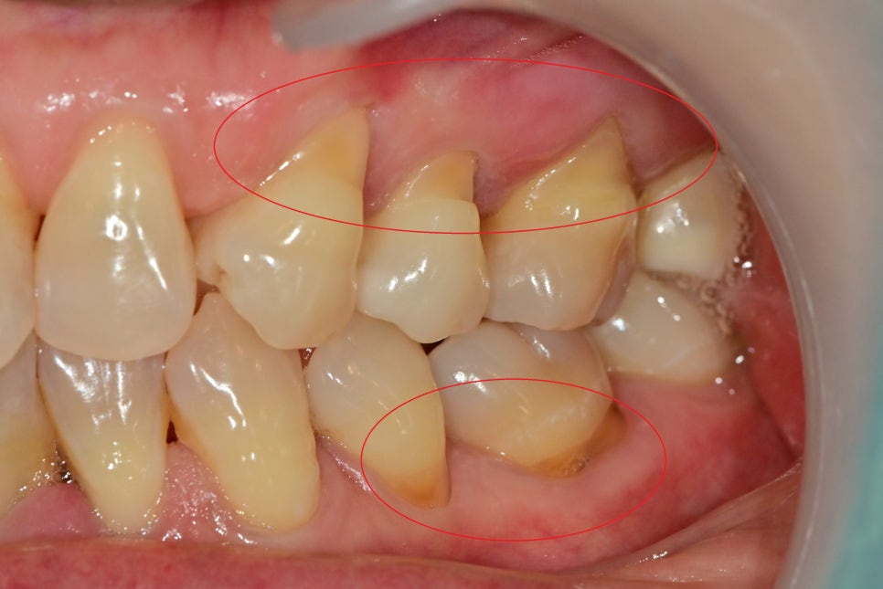 약수역치과, 턱관절 관련 질환(보톡스 치료) 관련 이미지 6