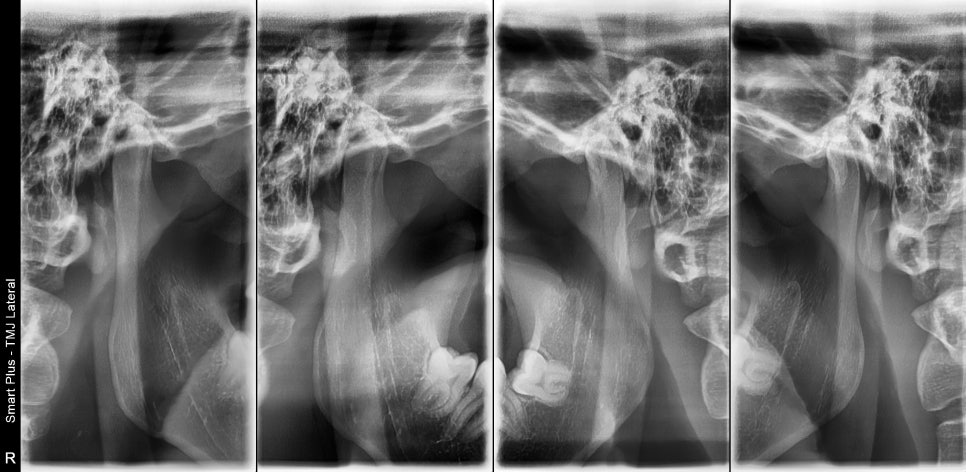 약수역치과, 턱관절 관련 질환(보톡스 치료) 관련 이미지 3